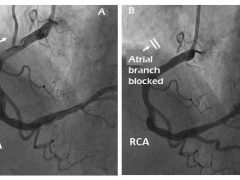 Atrial coronary artery occlusions and atrial ischemia are related to atrial fibrillation